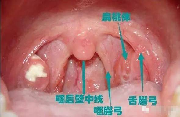 扁桃體發(fā)炎（腫大）Ⅰ-Ⅲ度圖片！詳細(xì)圖解