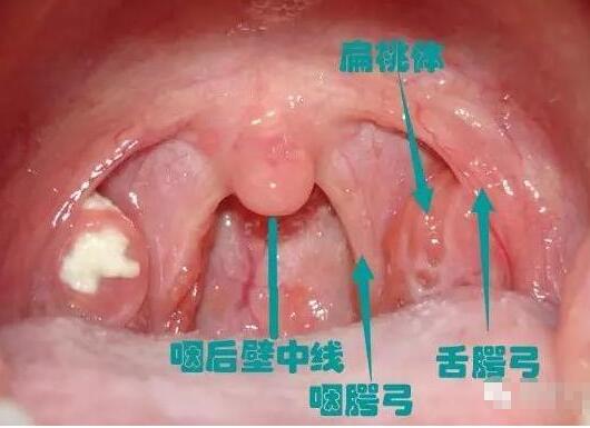 正常人的扁桃體圖片你知道長什么樣嗎？