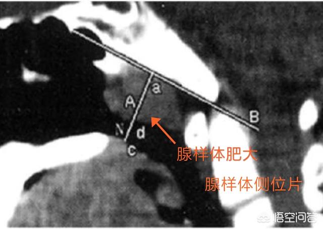 怎樣確定孩子是否是腺樣體肥大？