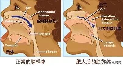 一歲四個月寶寶腺樣體肥大，除了手術(shù)還有什么辦法嗎？