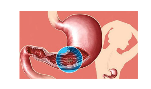如何判斷你的胃病是哪種類型，你中招了嗎