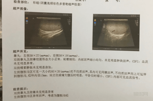 做了疝氣手術(shù)太后悔了，腹股溝疝氣保守治療（真實(shí)記錄分享）